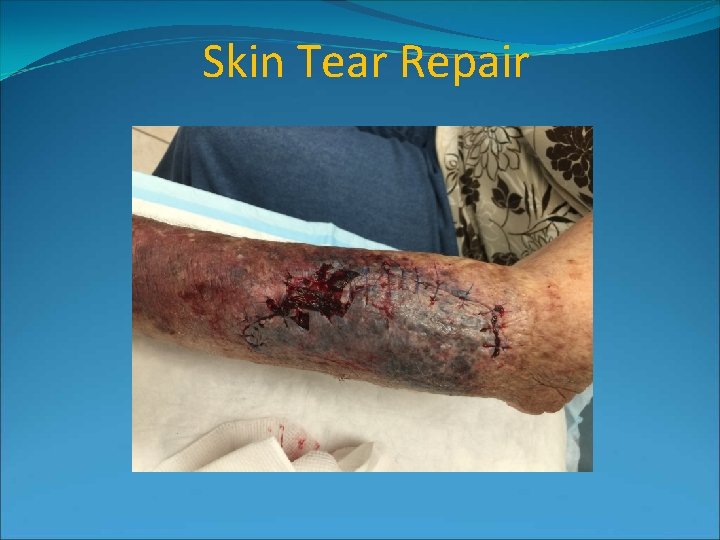 Skin Tear Repair 