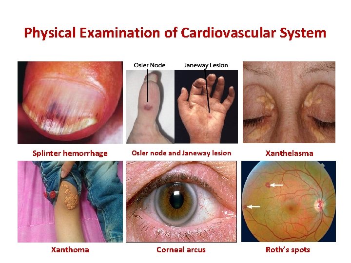 Physical Examination of Cardiovascular System Splinter hemorrhage Osler node and Janeway lesion Xanthelasma Xanthoma