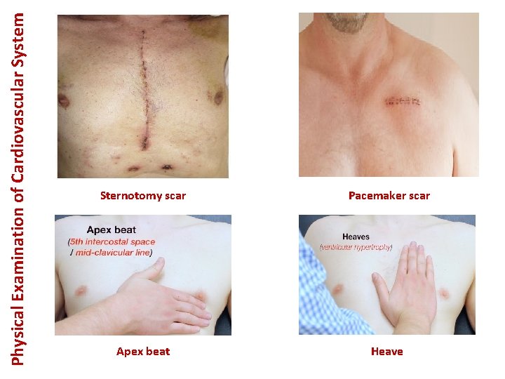 Physical Examination of Cardiovascular System Sternotomy scar Pacemaker scar Apex beat Heave 