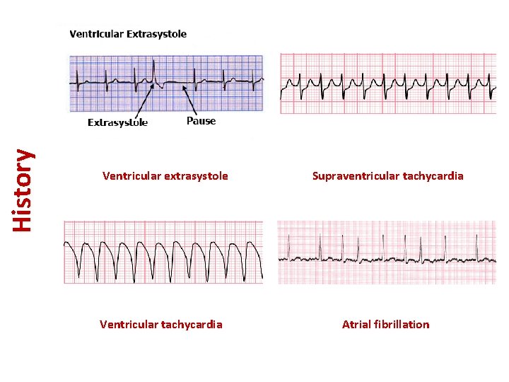 History Ventricular extrasystole Ventricular tachycardia Supraventricular tachycardia Atrial fibrillation 