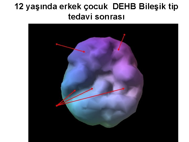 12 yaşında erkek çocuk DEHB Bileşik tip tedavi sonrası Prof. Dr. Ayşe Avcı Gaziantep