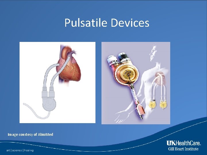 Pulsatile Devices Image courtesy of Abio. Med 