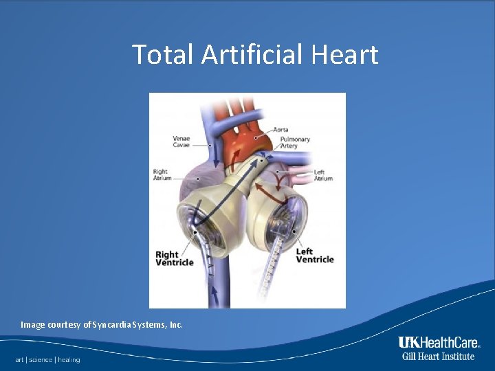 Total Artificial Heart Image courtesy of Syncardia Systems, Inc. 