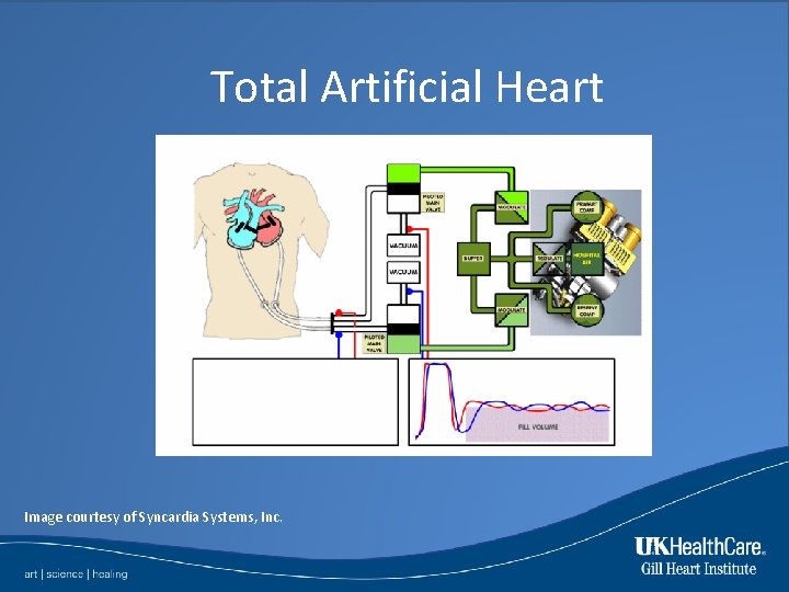 Total Artificial Heart Image courtesy of Syncardia Systems, Inc. 