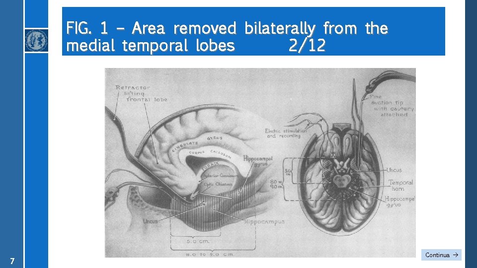 FIG. 1 – Area removed bilaterally from the medial temporal lobes 2/12 7 Continua