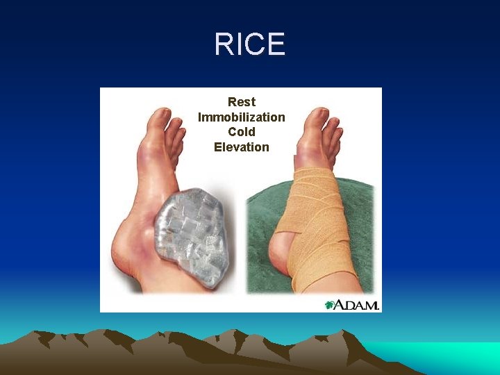 RICE Rest Immobilization Cold Elevation 