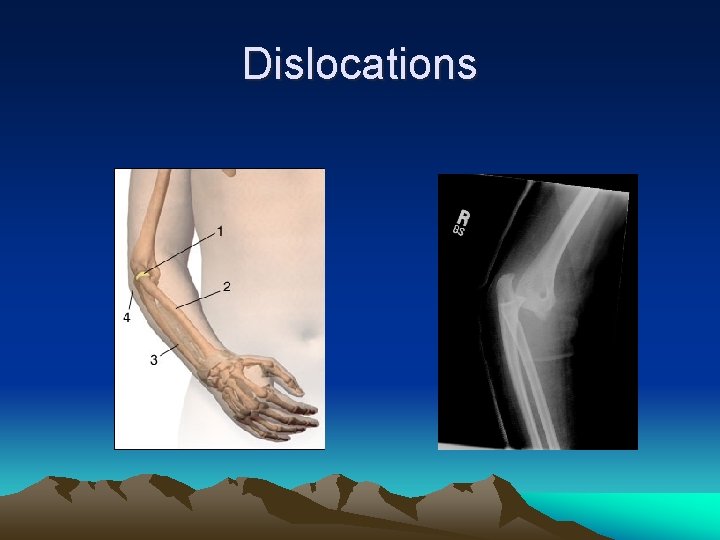 Dislocations 