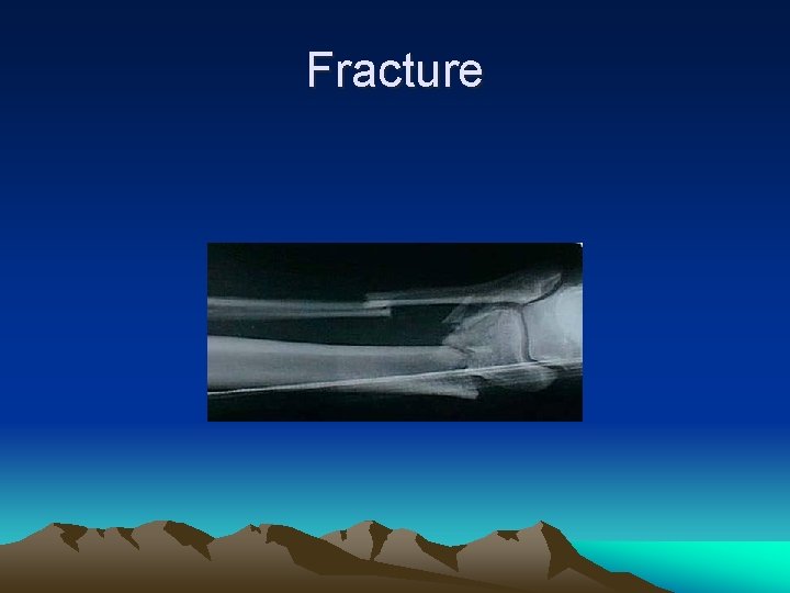 Fracture 