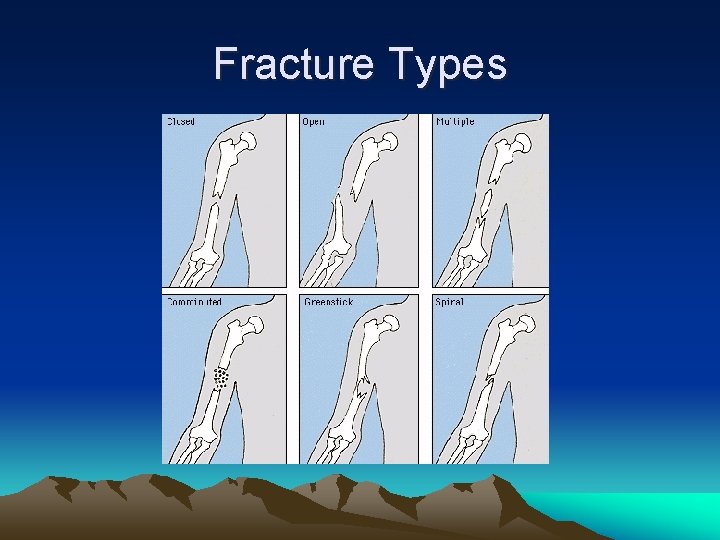 Fracture Types 