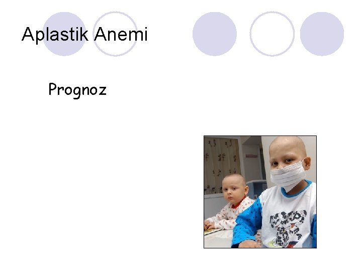Aplastik Anemi Prognoz 
