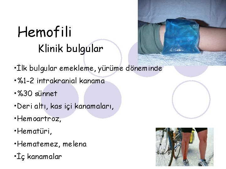 Hemofili Klinik bulgular • İlk bulgular emekleme, yürüme döneminde • %1 -2 intrakranial kanama