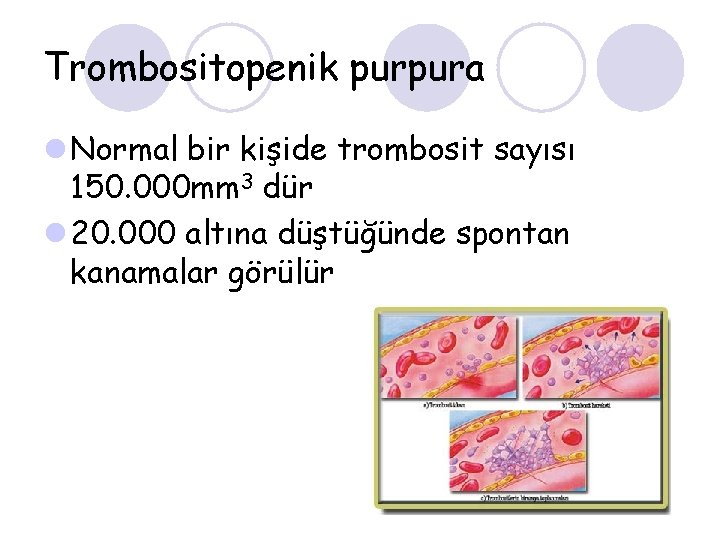 Trombositopenik purpura l Normal bir kişide trombosit sayısı 150. 000 mm 3 dür l