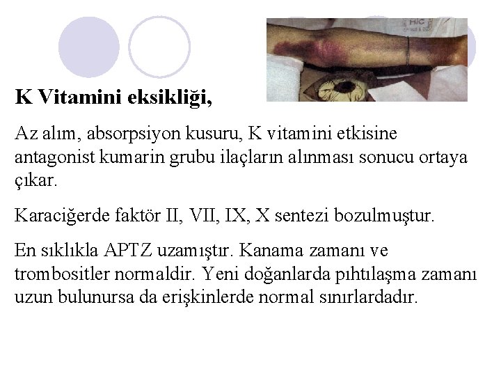K Vitamini eksikliği, Az alım, absorpsiyon kusuru, K vitamini etkisine antagonist kumarin grubu ilaçların