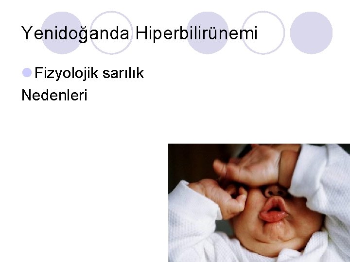 Yenidoğanda Hiperbilirünemi l Fizyolojik sarılık Nedenleri 