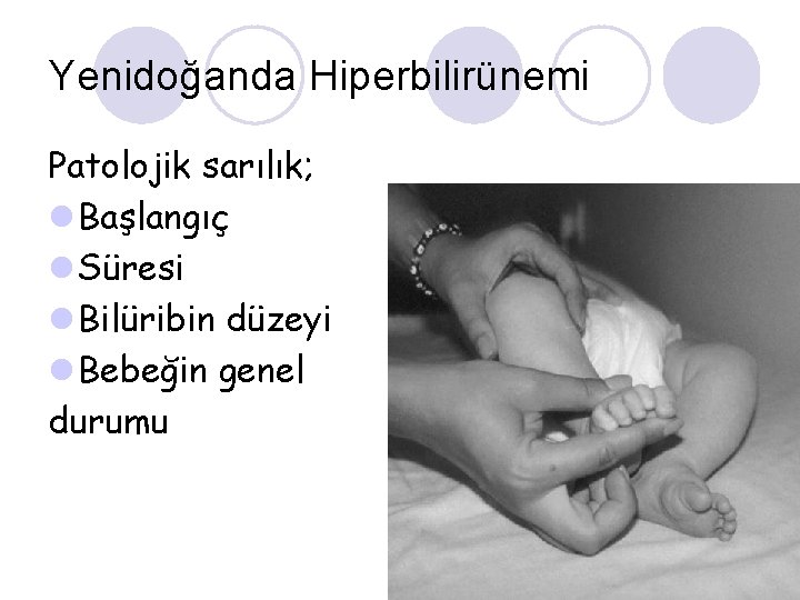 Yenidoğanda Hiperbilirünemi Patolojik sarılık; l Başlangıç l Süresi l Bilüribin düzeyi l Bebeğin genel