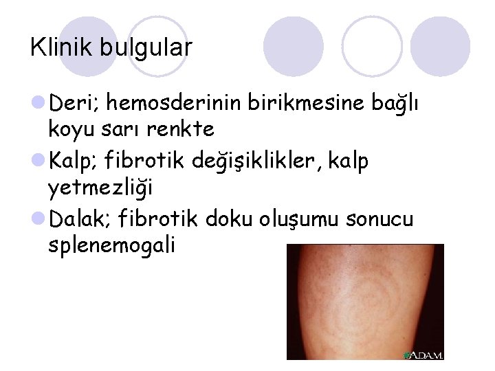 Klinik bulgular l Deri; hemosderinin birikmesine bağlı koyu sarı renkte l Kalp; fibrotik değişiklikler,