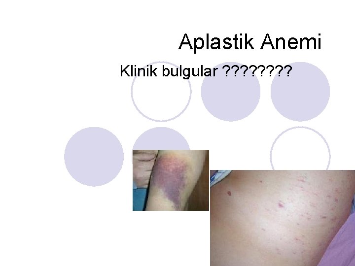 Aplastik Anemi Klinik bulgular ? ? ? ? 