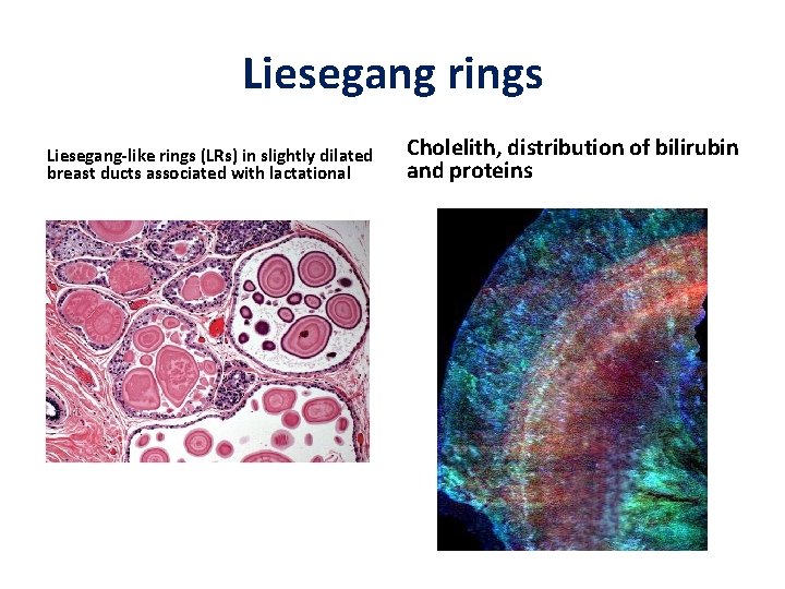 Liesegang rings Liesegang-like rings (LRs) in slightly dilated breast ducts associated with lactational Cholelith,