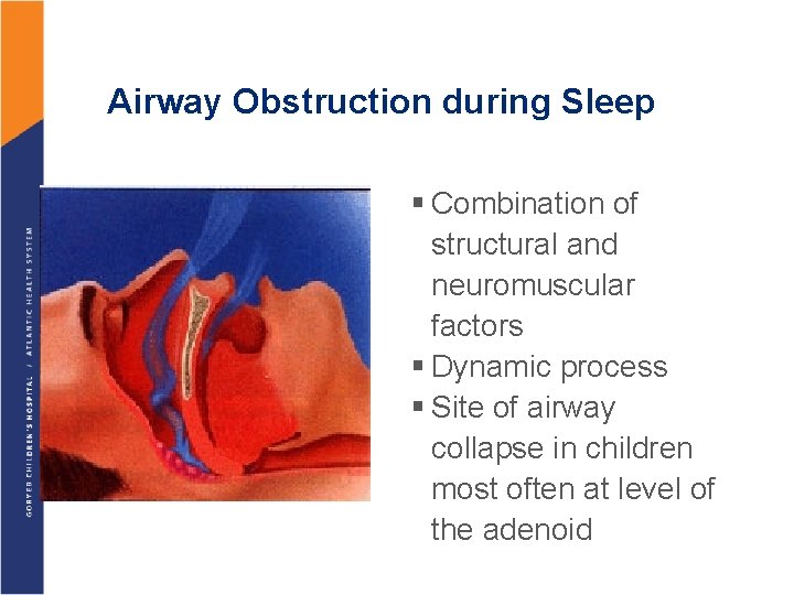 Airway Obstruction during Sleep § Combination of structural and neuromuscular factors § Dynamic process