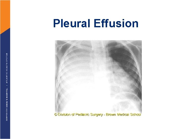 Pleural Effusion 