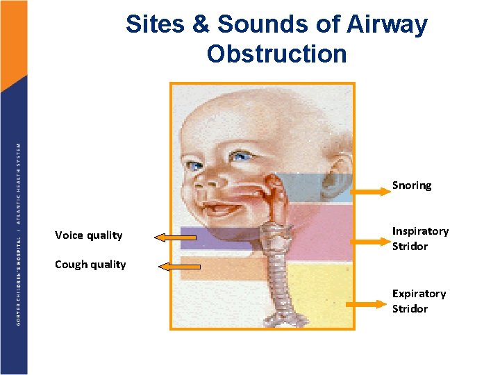 Sites & Sounds of Airway Obstruction Snoring Voice quality Inspiratory Stridor Cough quality Expiratory
