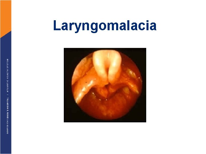 Laryngomalacia 