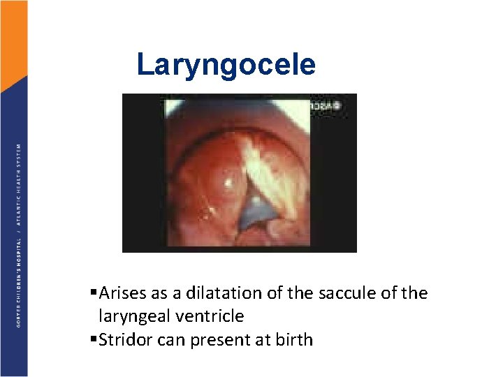 Laryngocele §Arises as a dilatation of the saccule of the laryngeal ventricle §Stridor can