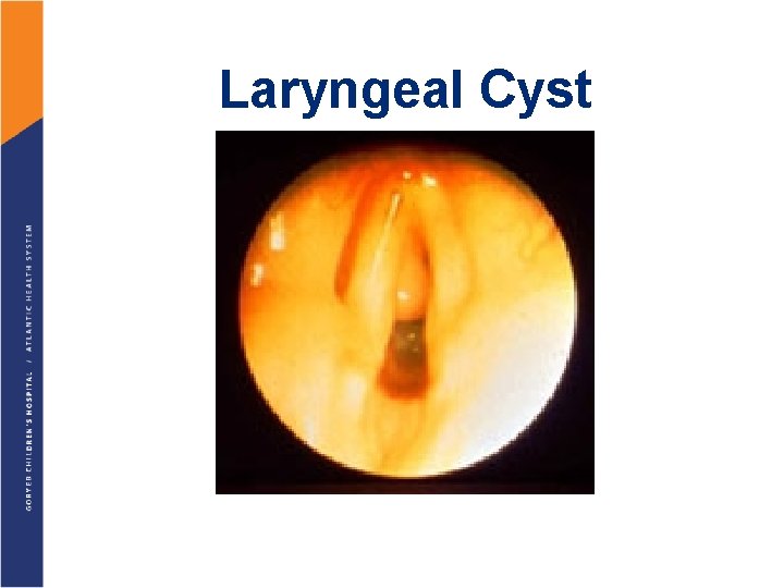 Laryngeal Cyst 