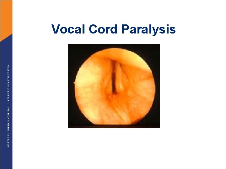 Vocal Cord Paralysis 