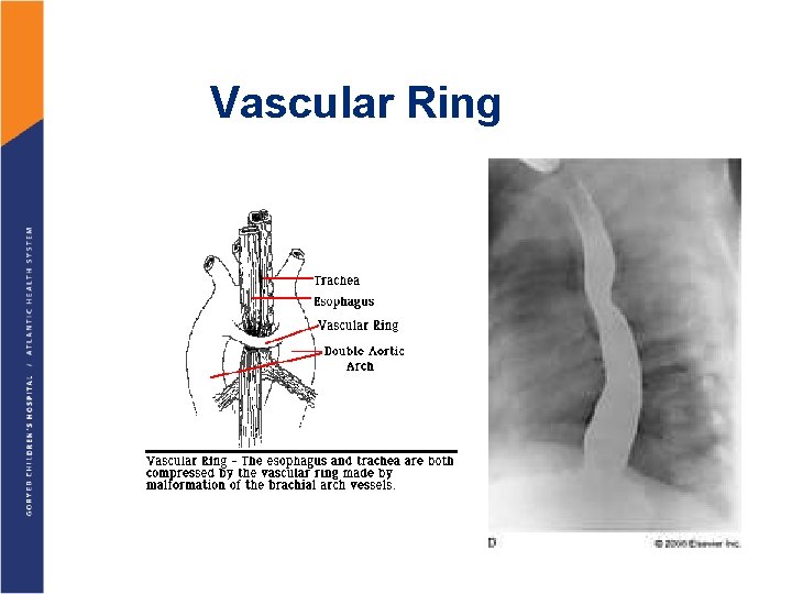 Vascular Ring 