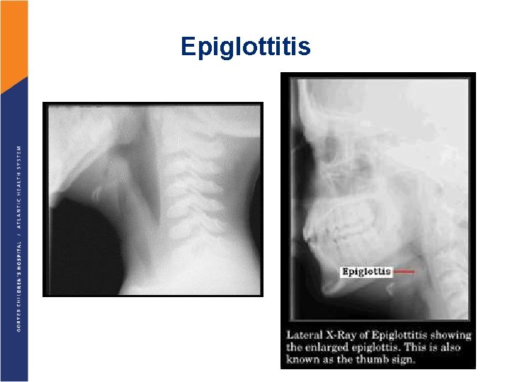 Epiglottitis 