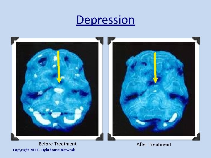 Depression Before Treatment Copyright 2013 - Lighthouse Network After Treatment 