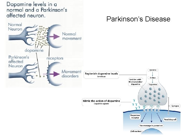 Parkinson’s Disease 