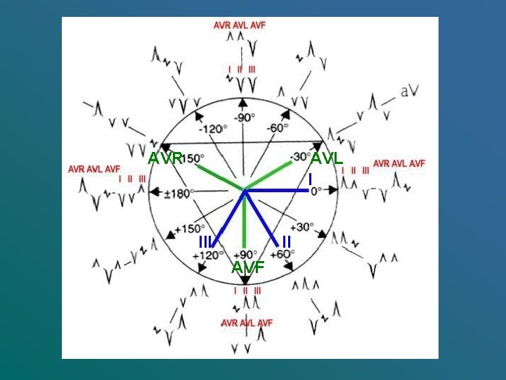 AVR AVL I II AVF 