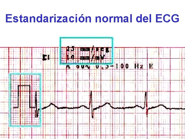 Estandarización normal del ECG 