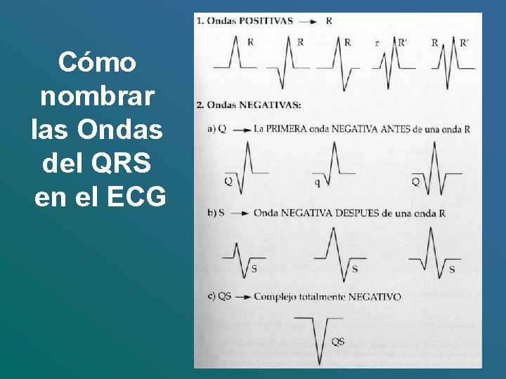 Cómo nombrar las Ondas del QRS en el ECG 