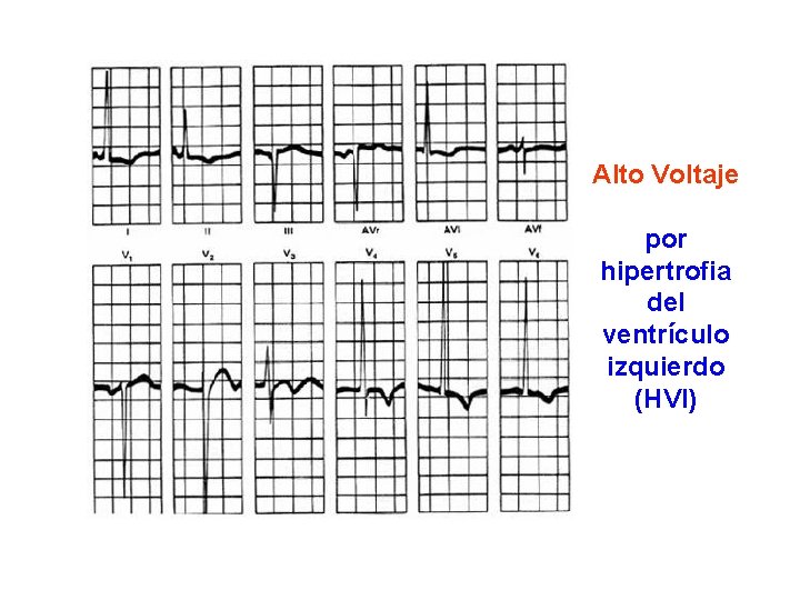 Alto Voltaje por hipertrofia del ventrículo izquierdo (HVI) 