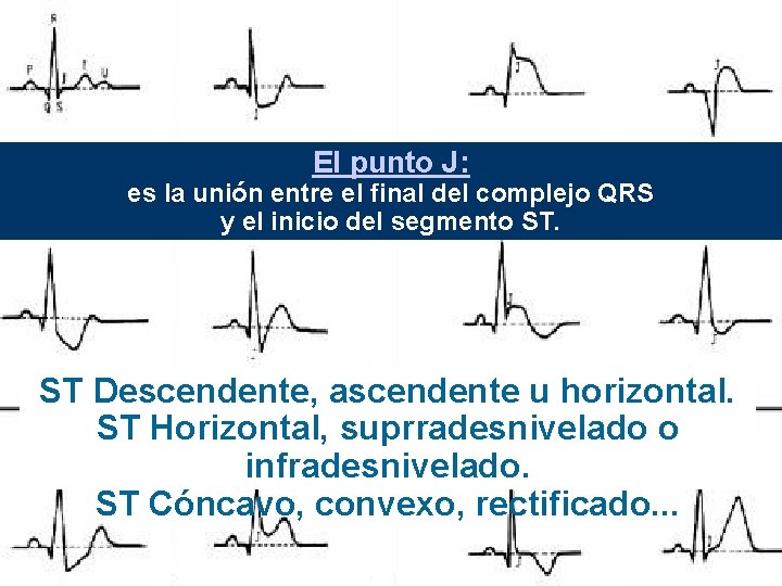 El punto J: es la unión entre el final del complejo QRS y el