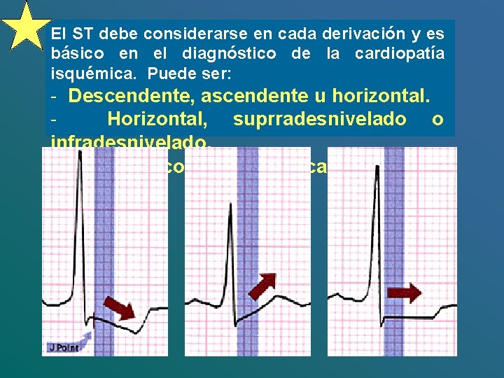 El ST debe considerarse en cada derivación y es básico en el diagnóstico de