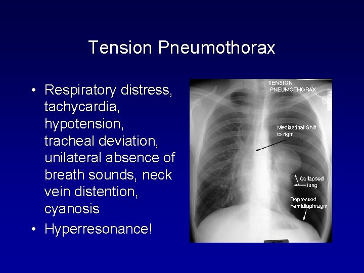 Tension Pneumothorax • Respiratory distress, tachycardia, hypotension, tracheal deviation, unilateral absence of breath sounds,