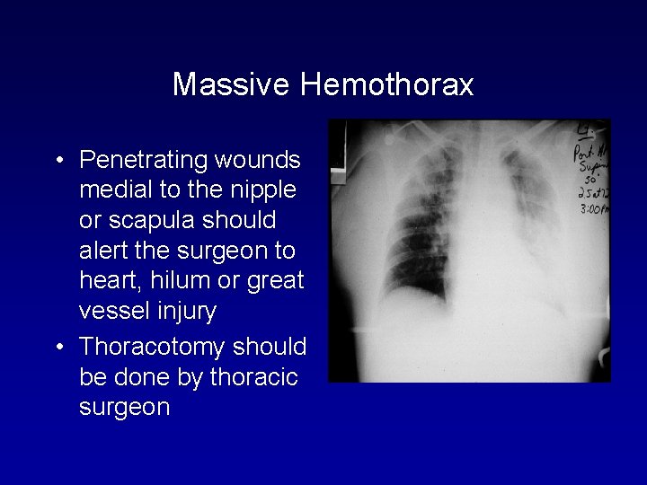 Massive Hemothorax • Penetrating wounds medial to the nipple or scapula should alert the