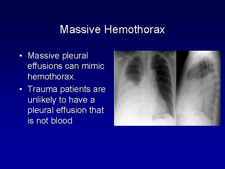 Massive Hemothorax • Massive pleural effusions can mimic hemothorax. • Trauma patients are unlikely