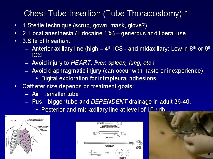 Chest Tube Insertion (Tube Thoracostomy) 1 • 1. Sterile technique (scrub, gown, mask, glove?