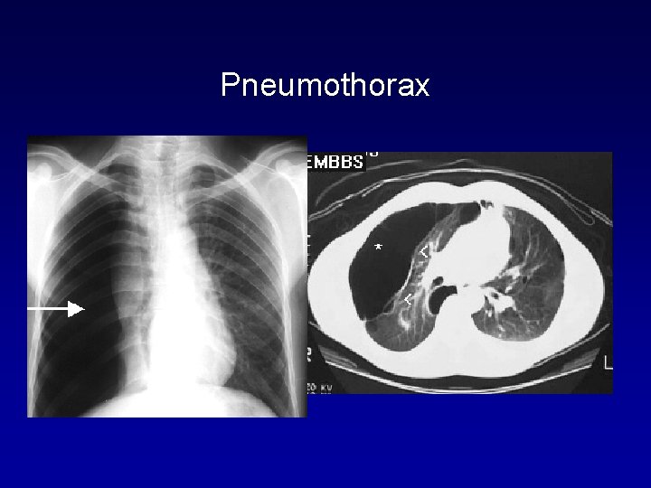 Pneumothorax 