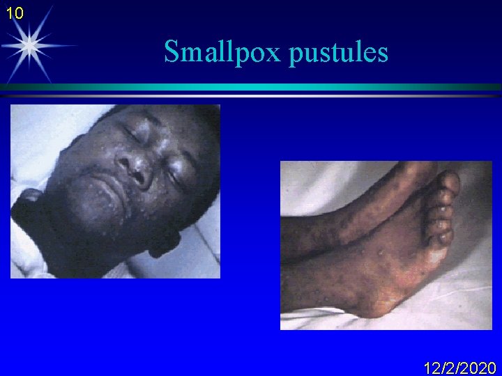 10 Smallpox pustules 12/2/2020 
