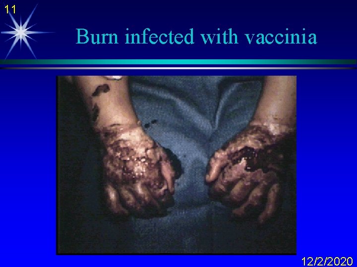 11 Burn infected with vaccinia 12/2/2020 