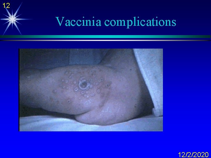 12 Vaccinia complications 12/2/2020 