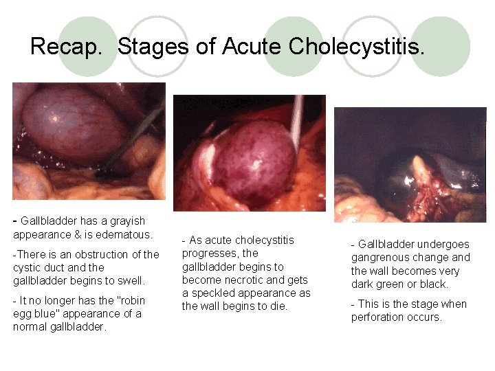 Recap. Stages of Acute Cholecystitis. - Gallbladder has a grayish appearance & is edematous.