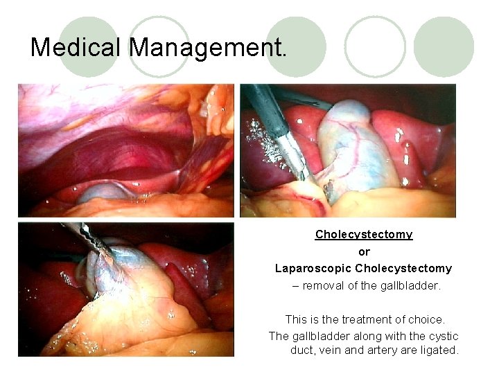 Medical Management. Cholecystectomy or Laparoscopic Cholecystectomy – removal of the gallbladder. This is the