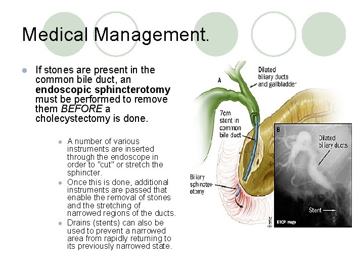 Medical Management. l If stones are present in the common bile duct, an endoscopic